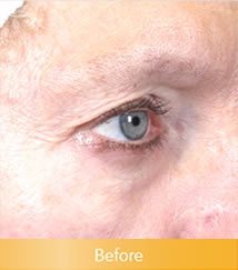 Ulthera02Before
